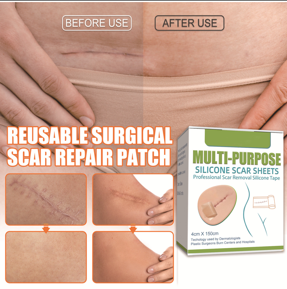 Medical Grade Silicone Scar Sheets/Tape (1.6”x 60”), for Post-Surgery Scars